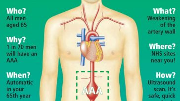 What is Abdominal Aortic Aneurysm (AAA)