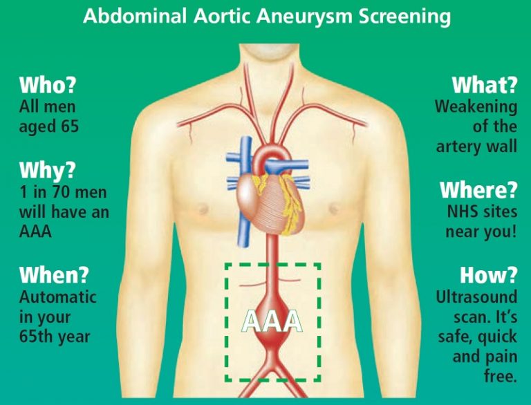 What is Abdominal Aortic Aneurysm (AAA)