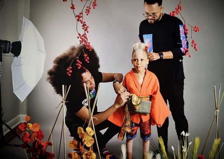 Brazilian boy with rare skin disease becomes international model